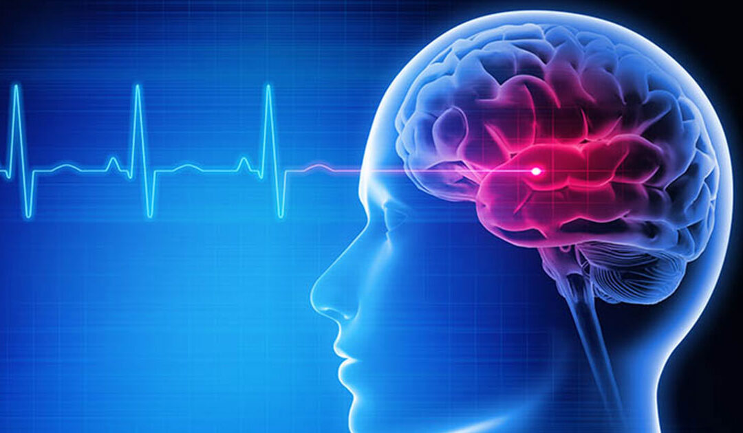 signs and symptoms of stroke